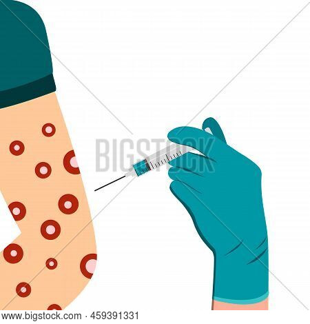 Vaccination Against Monkeypox Virus In The Shoulder And Arm With A Syringe. Eruption On The Body. Mo