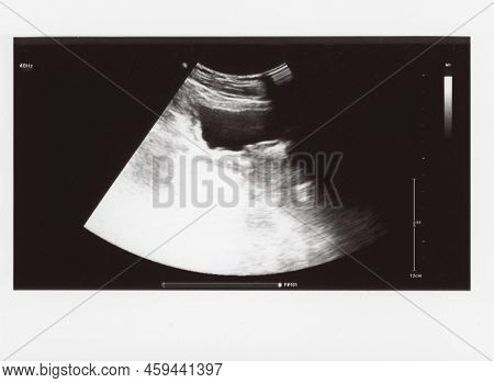 Full Abdomen Ultrasound Sonogram