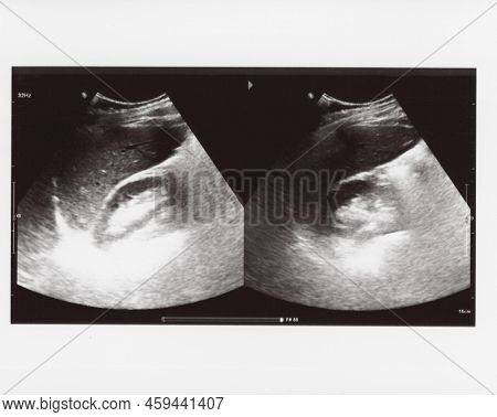 Full Abdomen Ultrasound Sonogram