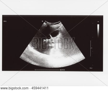 Full Abdomen Ultrasound Sonogram