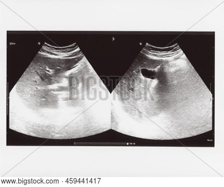 Full Abdomen Ultrasound Sonogram