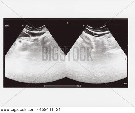 Full Abdomen Ultrasound Image Aka Diagnostic Sonogram