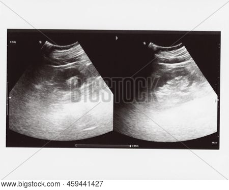 Full Abdomen Ultrasound Image Aka Diagnostic Sonogram