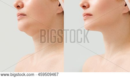 Female Double Chin Before And After Correction. Correction Of The Chin Shape Liposuction Of The Neck