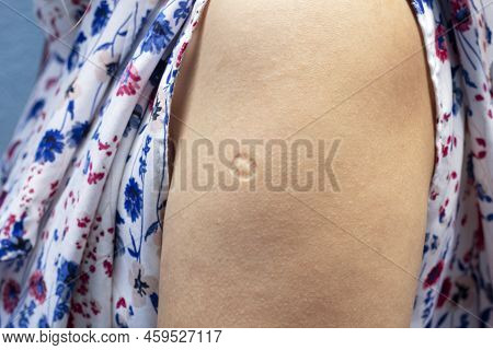 Bacillus Calmette-guern Vaccine,  Bcg Or Tb Vaccine Scar Mark At The Arm Of Southeast Asian Women.
