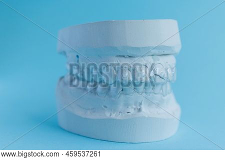 Gypsum Mould Of Human Jaw With Transparent Aligner, Invisible Retainer Or Orthodontic Silicone Train
