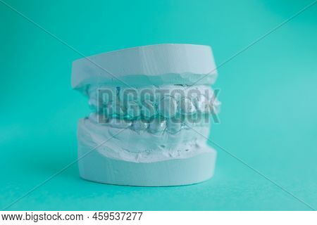Plaster Model Of The Human Jaw With Transparent Silicone Essix Retainer For Dental Correction