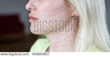 Real Biorevitalization Of The Skin On A White Background. Traces Of Injections Of Biorevitalization 