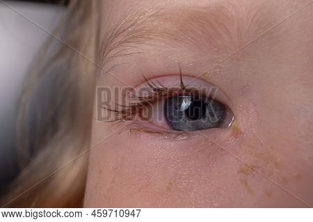 Purulent Inflammation Of The Eyes, Conjunctivitis In The Eyes Of A Caucasian Child.