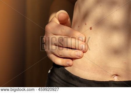 Birthmarks On Skin Close Up Detail Of The Bare Skin Sun Exposure Effect On Skin, Health Effects Of U