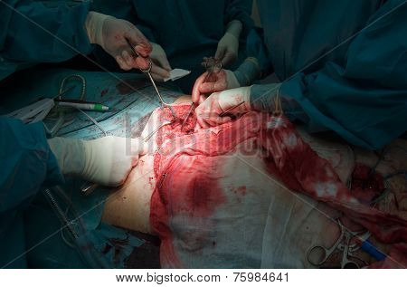 Surgeons Operating In Hospital