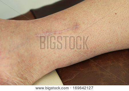 Old Human Leg With Postoperative Scar Of Cardiac Surgery. Heart Disease. Medical Concept
