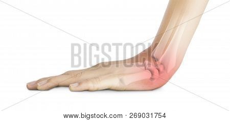 Wrist Bones Injury White Background Wrist Pain