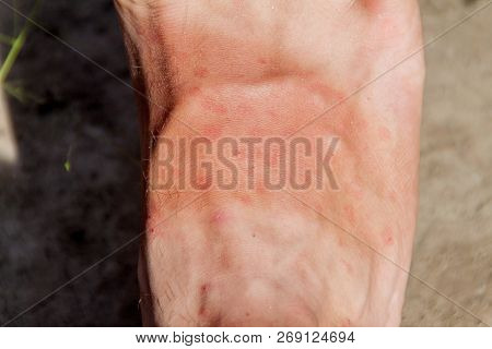 Leg Covered By The Bites Of Sandflies, Jungle In Peru
