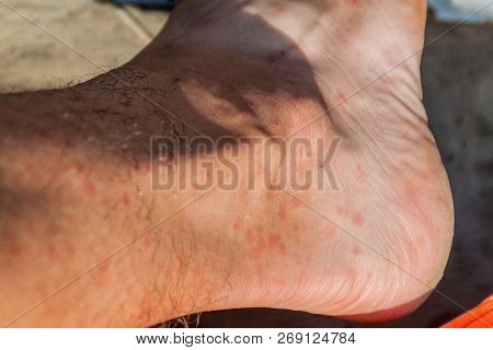 Leg Covered By The Bites Of Sandflies, Jungle In Peru