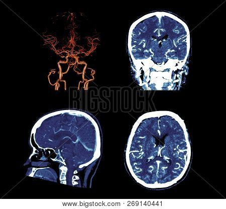 Multi View 2d And 3d Rendering Image Of Cta Human Brain . Stroke Disease Concept.
