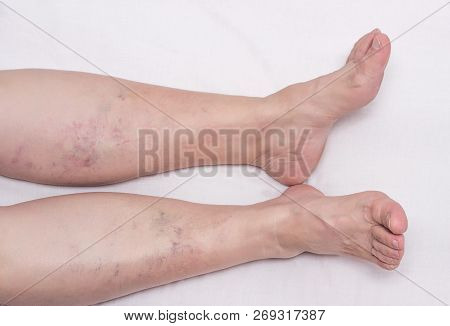 Varicose Veins In The Legs Of A Woman, White Background, Varicose Veins On The Calves Of The Legs An