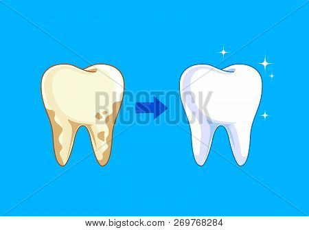 Tooth Before And After. Yellow Becomes White, Dental Care Concept,  Illustration Isolated On Blue Ba