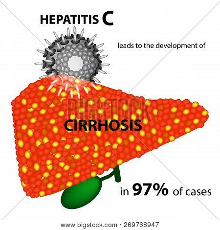 Hepatitis C Leads To The Development Of Cirrhosis In 97 Percent Of Cases. Infographics. Vector Illus