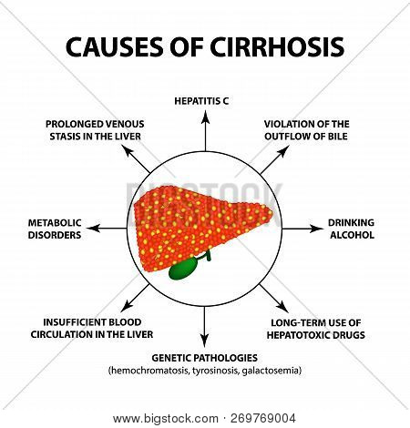 Causes Of Cirrhosis. Infographics. Vector Illustration On Isolated Background.