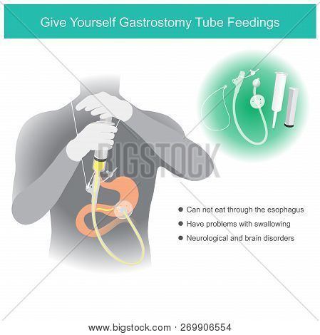 Use A Feeding Tube And Balloon Latch Locked As Device Inserted Into Your Stomach Through The Abdomen