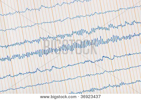 심전도 Ecg