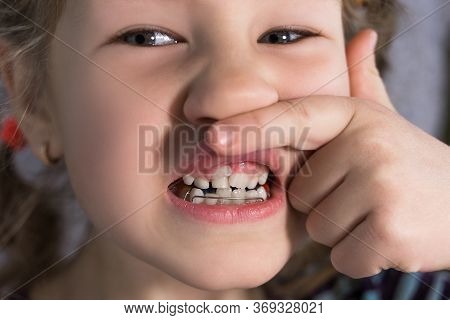 Adult Permanent Teeth Coming In Front Of The Child's Baby Teeth: Shark Teeth. Little Girl's Open Mou