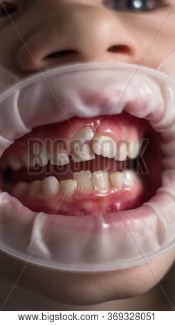Adult Permanent Teeth Coming In Front Of The Child's Baby Teeth: Shark Teeth. Little Girl's Open Mou