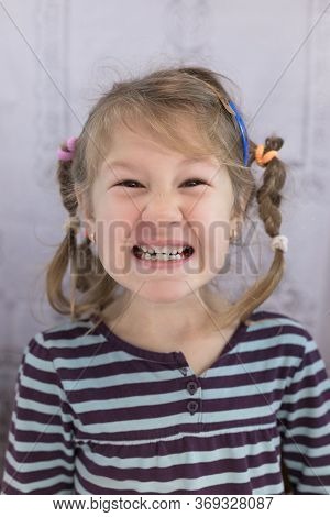 Adult Permanent Teeth Coming In Front Of The Child's Baby Teeth: Shark Teeth. Little Girl's Open Mou