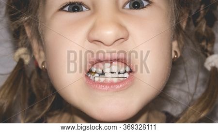Adult Permanent Teeth Coming In Front Of The Child's Baby Teeth: Shark Teeth. Little Girl's Open Mou
