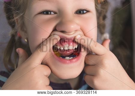Adult Permanent Teeth Coming In Front Of The Child's Baby Teeth: Shark Teeth. Little Girl's Open Mou