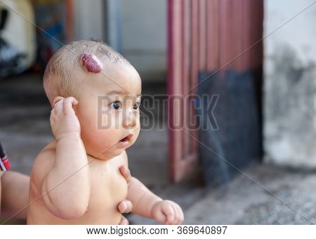 An Adorable Little Child Girl With Big Capillary Strawberry Hemangiomas Red Birthmark On The Head Is