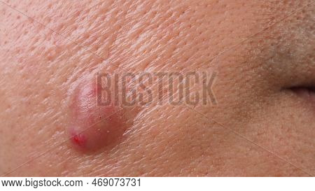 Big Acne Cyst Abscess Or Ulcer Swollen Area Within Face Skin Tissue.