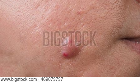Big Acne Cyst Abscess Or Ulcer Swollen Area Within Face Skin Tissue.