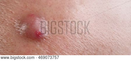 Big Acne Cyst Abscess Or Ulcer Swollen Area Within Face Skin Tissue.