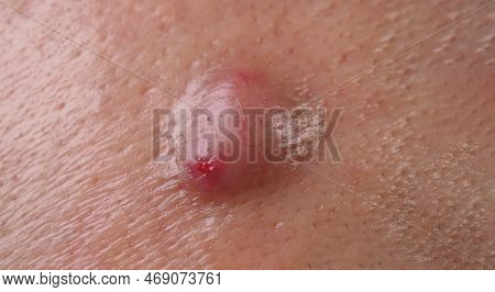 Big Acne Cyst Abscess Or Ulcer Swollen Area Within Face Skin Tissue.