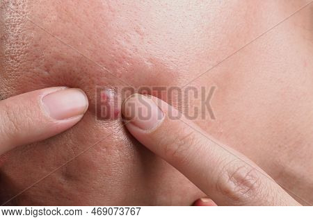 Big Acne Cyst Abscess Or Ulcer Swollen Area Within Face Skin Tissue.