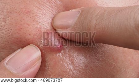 Big Acne Cyst Abscess Or Ulcer Swollen Area Within Face Skin Tissue.