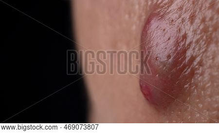 Big Acne Cyst Abscess Or Ulcer Swollen Area Within Face Skin Tissue.