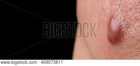 Big Acne Cyst Abscess Or Ulcer Swollen Area Within Face Skin Tissue.
