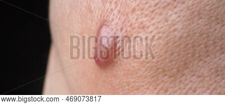 Big Acne Cyst Abscess Or Ulcer Swollen Area Within Face Skin Tissue.