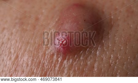 Big Acne Cyst Abscess Or Ulcer Swollen Area Within Face Skin Tissue.