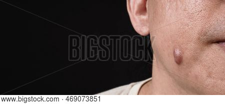 Big Acne Cyst Abscess Or Ulcer Swollen Area Within Face Skin Tissue.
