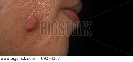 Big Acne Cyst Abscess Or Ulcer Swollen Area Within Face Skin Tissue.