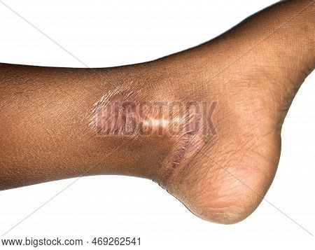 Hypertrophic Scar At The Leg Of Asian Child. Isolated On White.