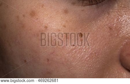 Freckles And Brown Spots On The Oily Face Of Asian Young Woman.