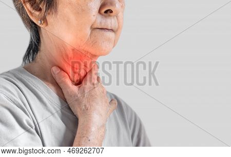 Redness At The Neck Of Asian, Myanmar Woman. Concept Of Sore Throat, Pharyngitis, Laryngitis, Esopha