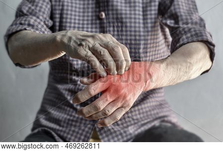 Asian Elder Woman Scratching Her Hand. Concept Of Itchy Skin Diseases Such As Scabies, Fungal Infect