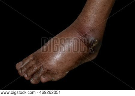 Unilateral Edema Of Upper Limbs. Swollen Leg And Foot Of Asian Man. Isolated On White.