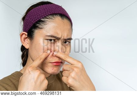 Worried Asian Woman Pointing To Acne Inflamed On Her Face. Inflamed Acne Consists Of Swelling, Redne